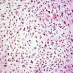 10 Symptoms of chondrosarcoma You Should Never Ignore
