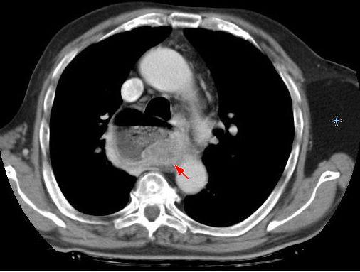 10 Symptoms of achalasia You Should Never Ignore