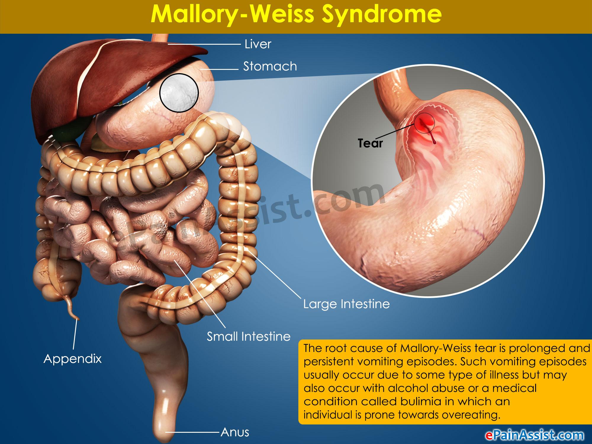 10 Symptoms of Mallory-Weiss syndrome You Should Never Ignore