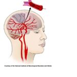 10 Symptoms of stroke You Should Never Ignore
