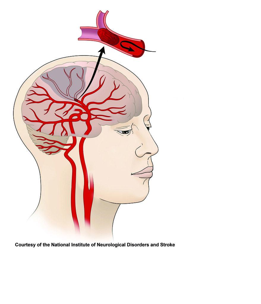 10 Symptoms of stroke You Should Never Ignore