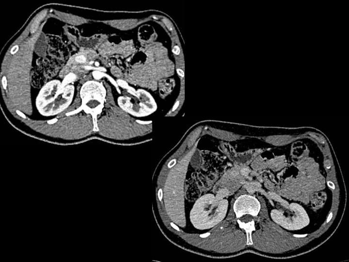 10 Symptoms of insulinoma You Should Never Ignore