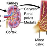 10 Symptoms of hydronephrosis You Should Never Ignore