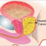 10 Symptoms of prostate cancer You Should Never Ignore