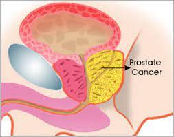 10 Symptoms of prostate cancer You Should Never Ignore