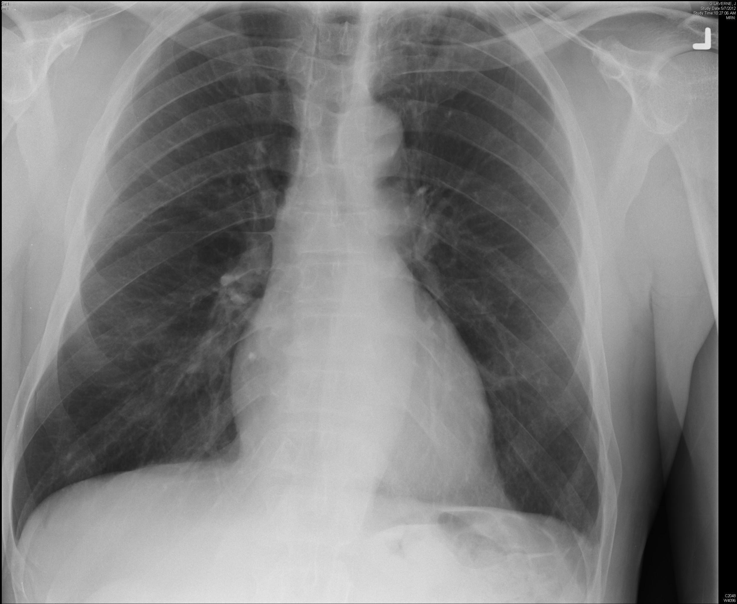 10 Symptoms of Wegenerʼs granulomatosis You Should Never Ignore