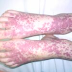 10 Symptoms of Henoch-Schönlein purpura You Should Never Ignore