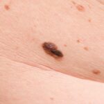 10 Symptoms of melanoma You Should Never Ignore