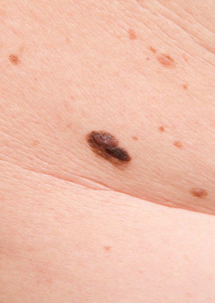 10 Symptoms of melanoma You Should Never Ignore