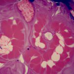 inflamed human gall bladder