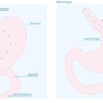 Gastric Surgery: A Life-Changing Solution for Weight Loss