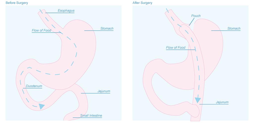 Gastric Surgery: A Life-Changing Solution for Weight Loss