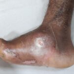 Understanding the Early Signs of Diabetic Foot Problems