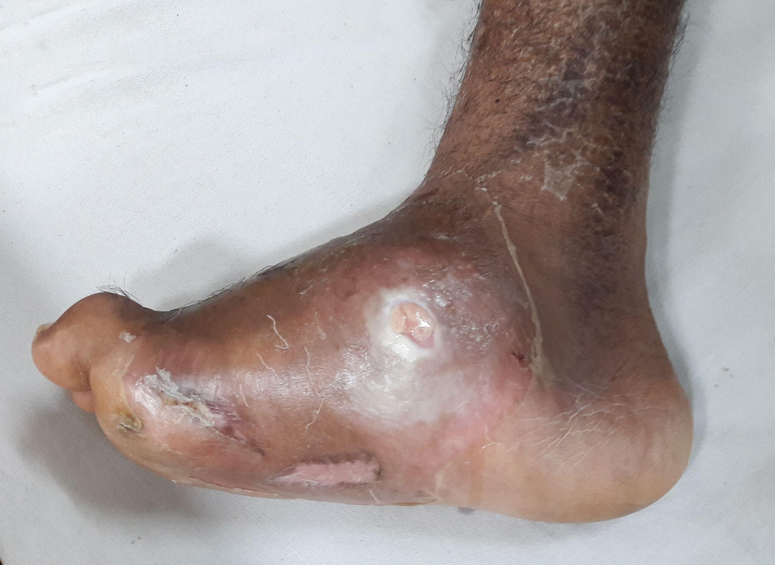 Understanding the Early Signs of Diabetic Foot Problems