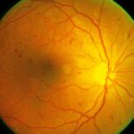 Understanding Non-Proliferative Diabetic Retinopathy: Causes, Symptoms, and Treatment Options