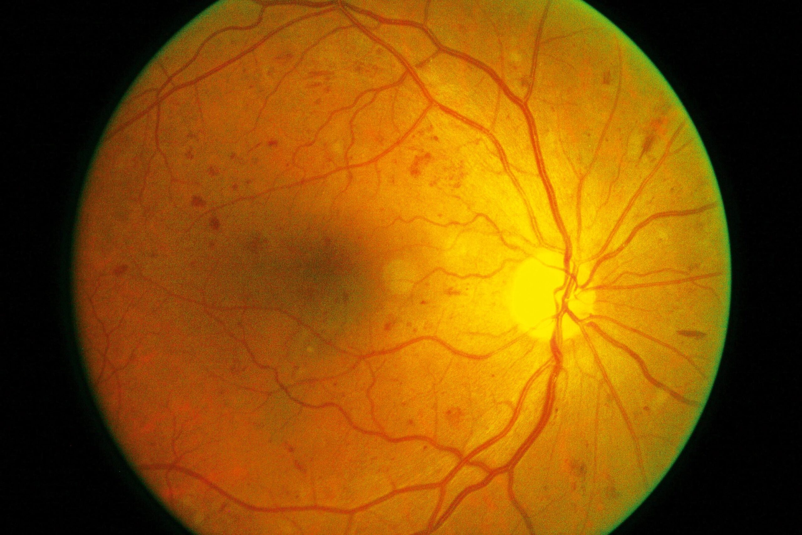 Understanding Non-Proliferative Diabetic Retinopathy: Causes, Symptoms, and Treatment Options