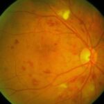 The Early Warning Signs of Retinopathy You Shouldn’t Ignore