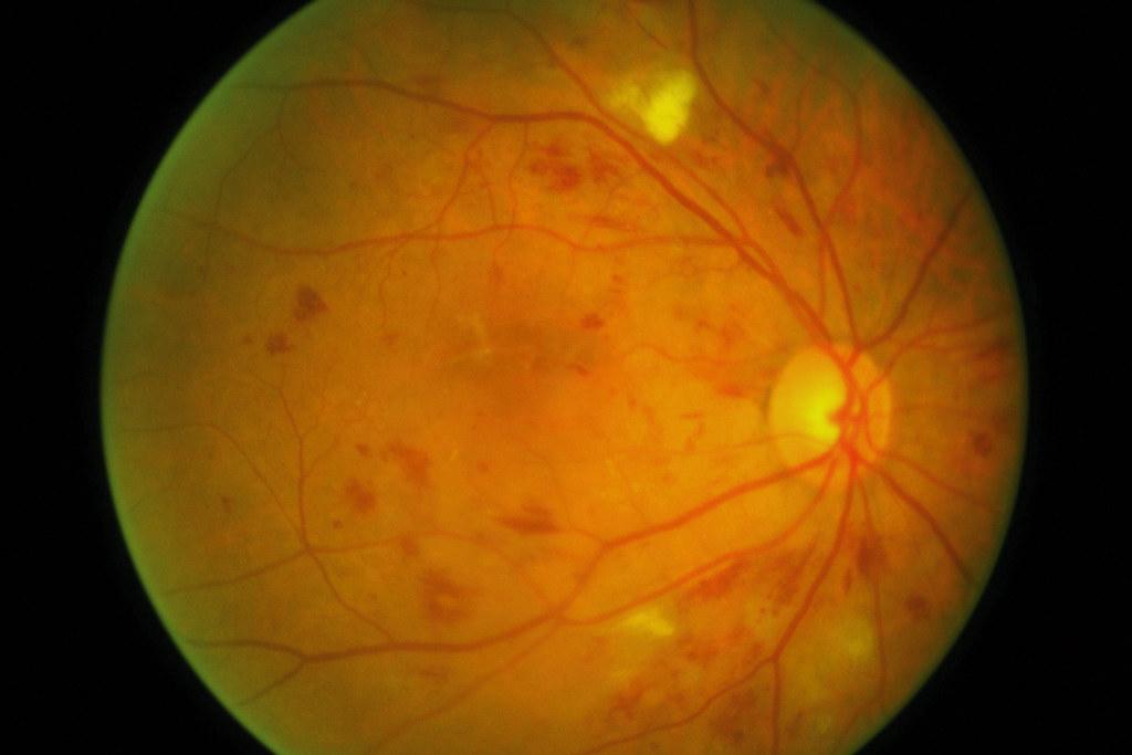 The Early Warning Signs of Retinopathy You Shouldn’t Ignore