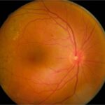 Recognizing the Warning Signs: Symptoms of Macular Edema