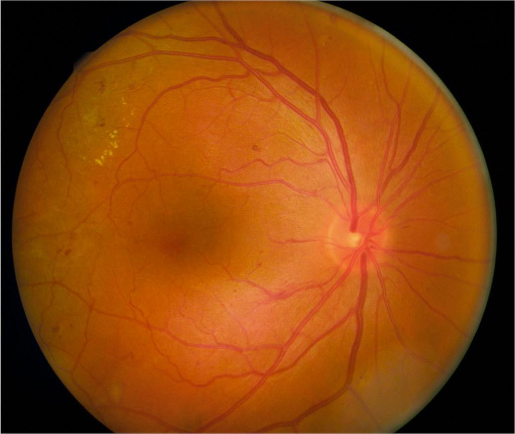 Recognizing the Warning Signs: Symptoms of Macular Edema