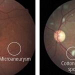 Understanding Proliferative Diabetic Retinopathy: Causes, Symptoms, and Treatment