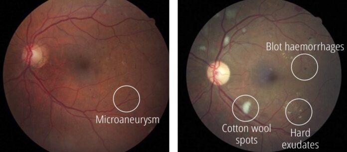 Understanding Proliferative Diabetic Retinopathy: Causes, Symptoms, and Treatment