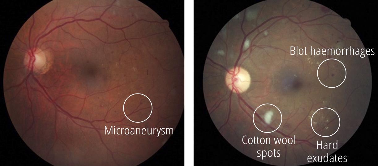 Understanding Proliferative Diabetic Retinopathy: Causes, Symptoms, and Treatment