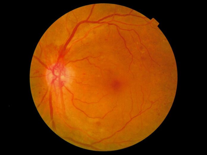 Understanding Proliferative Retinopathy: Causes and Symptoms