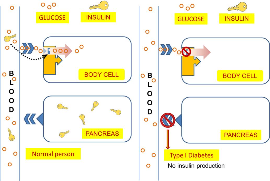 Understanding IDDM: What You Need to Know about Insulin-Dependent Diabetes Mellitus